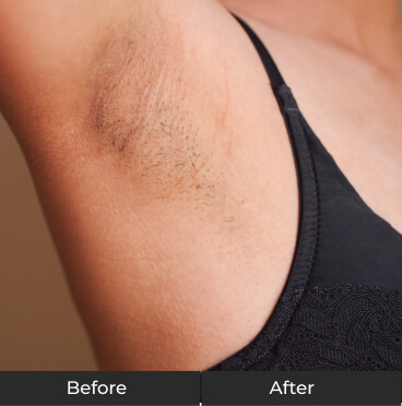 Laser Hair Removal - Before