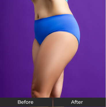 Skin Tightening - After