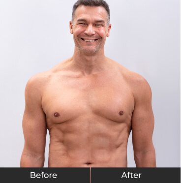 Weight Loss - After